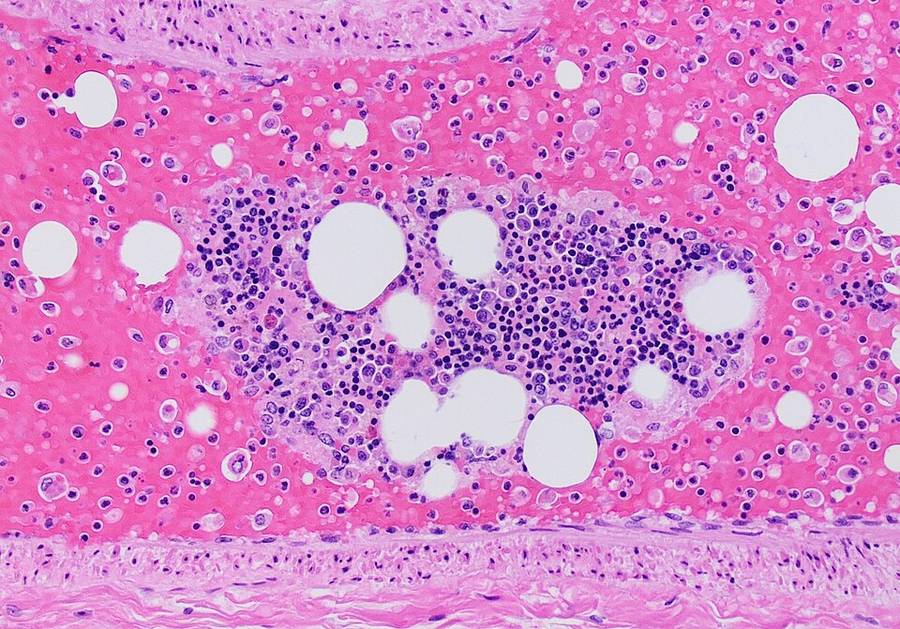 Embolia grasa en una arteria pulmonar (autopsia, hematoxilina-eosina)