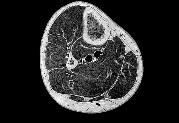 Corte transversal de la pierna a nivel medio (lámina 440 de Gray, 1918)